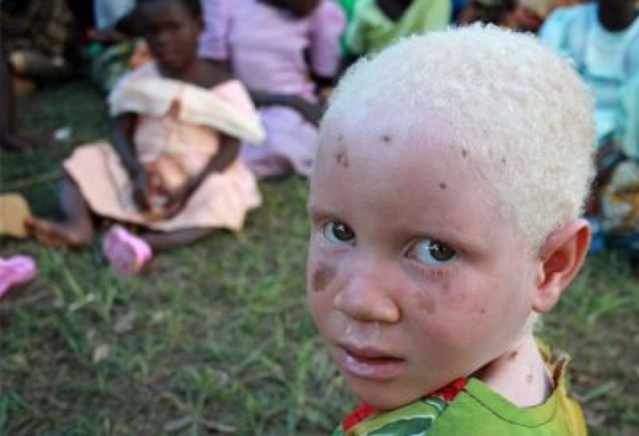 Expert appeals for action over upsurge in attacks against people with albinism