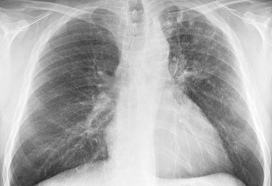 Weltweit sterben Millionen Menschen an Tuberkulose fast so viele wie an HI-Virus