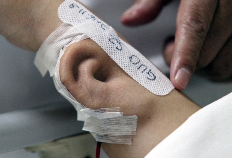Chinas Ärzte künstliches Ohr in Arm von Patient gepflanzt