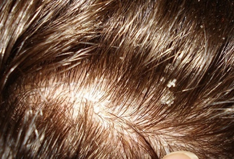 Ученые выявили причины возникновения чувствительной кожи головы