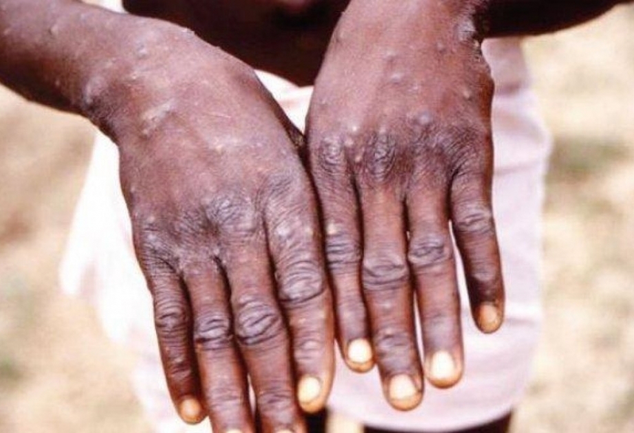 Monkeypox outbreak can still be contained, insists UN health agency