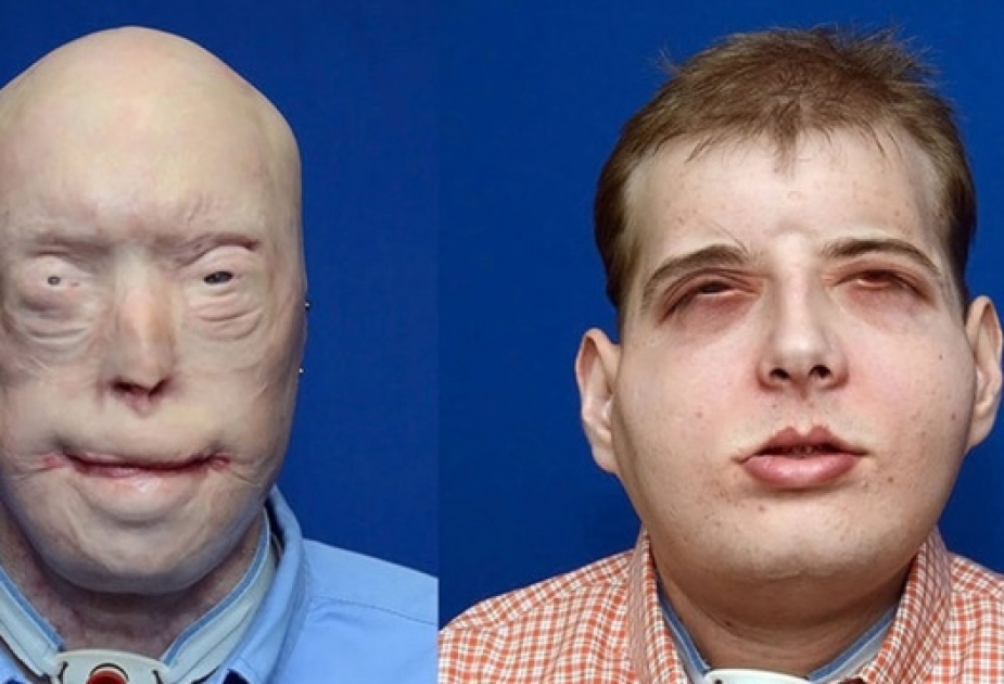 Injured firefighter gets most extensive face transplant ever