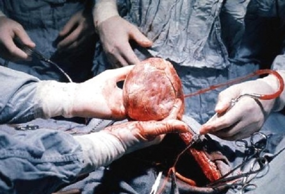 Хирурги достали из сердца пациента иглу в 4 см