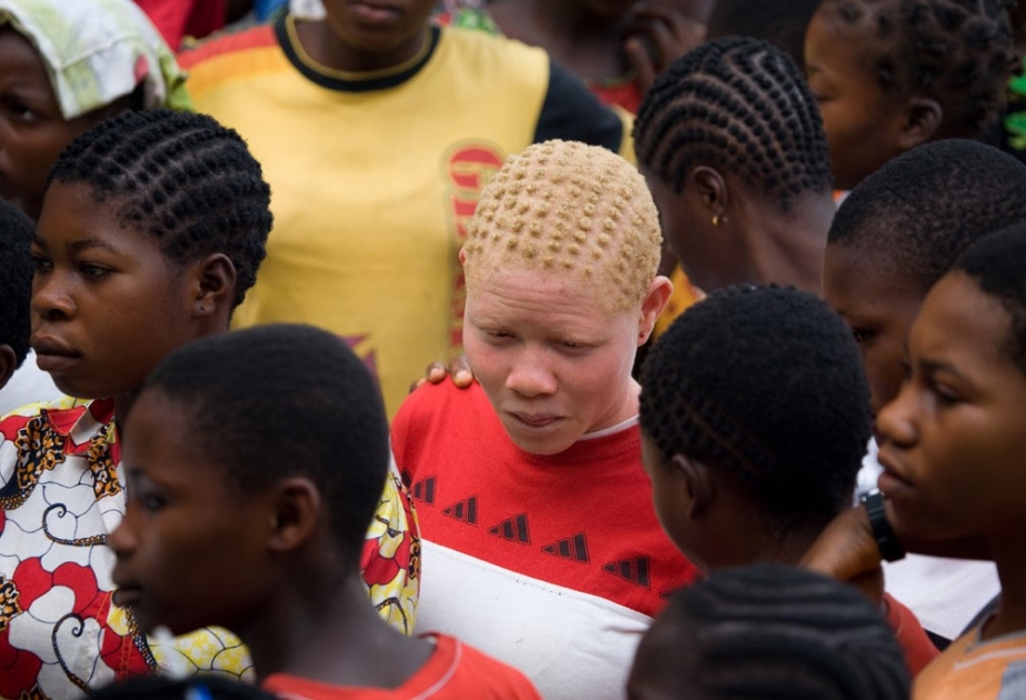 Страны Африки обсудят проблему защиты альбиносов