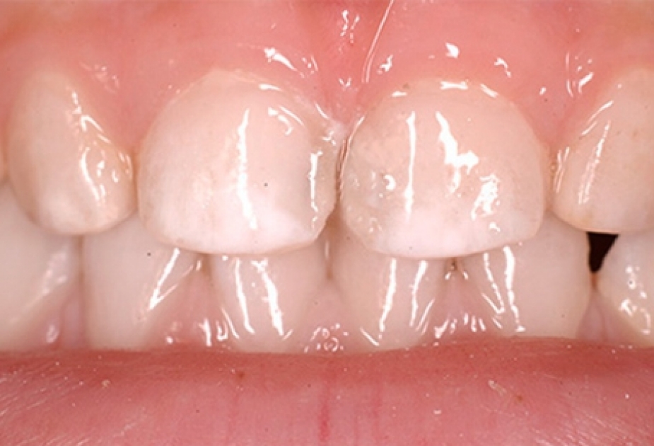 Diş emalındakı nanoelementlər kariyesin qarşısını alacaq