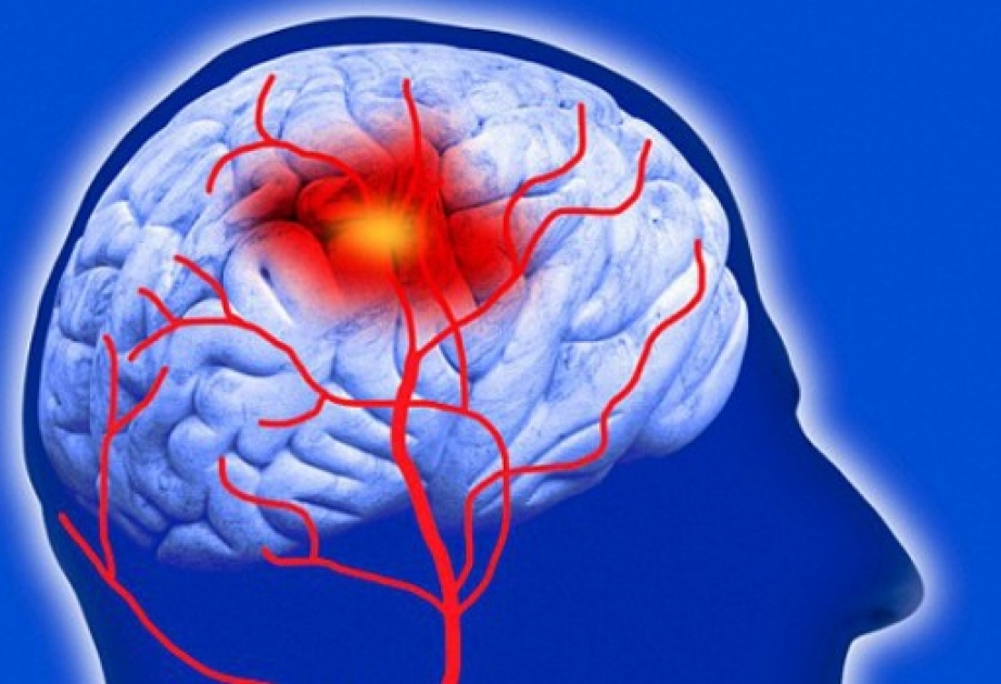 Наличие мигрени повышает вероятность возникновения инсульта во время операции