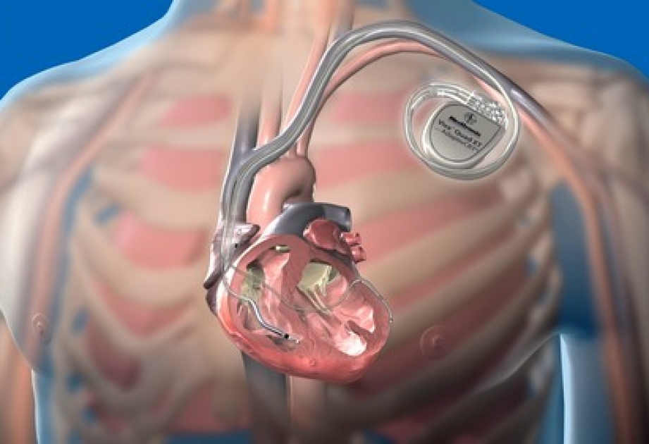 Американские ученые успешно имплантировали самый маленький в мире кардиостимулятор человеку