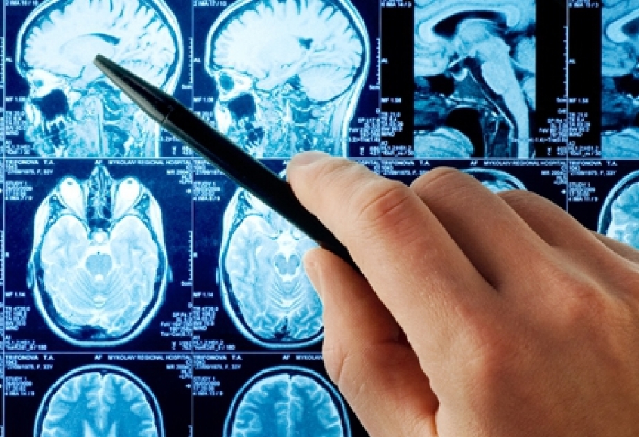 Beyin üçün faydalı olan yeyinti məhsullarının siyahısı tərtib olunub