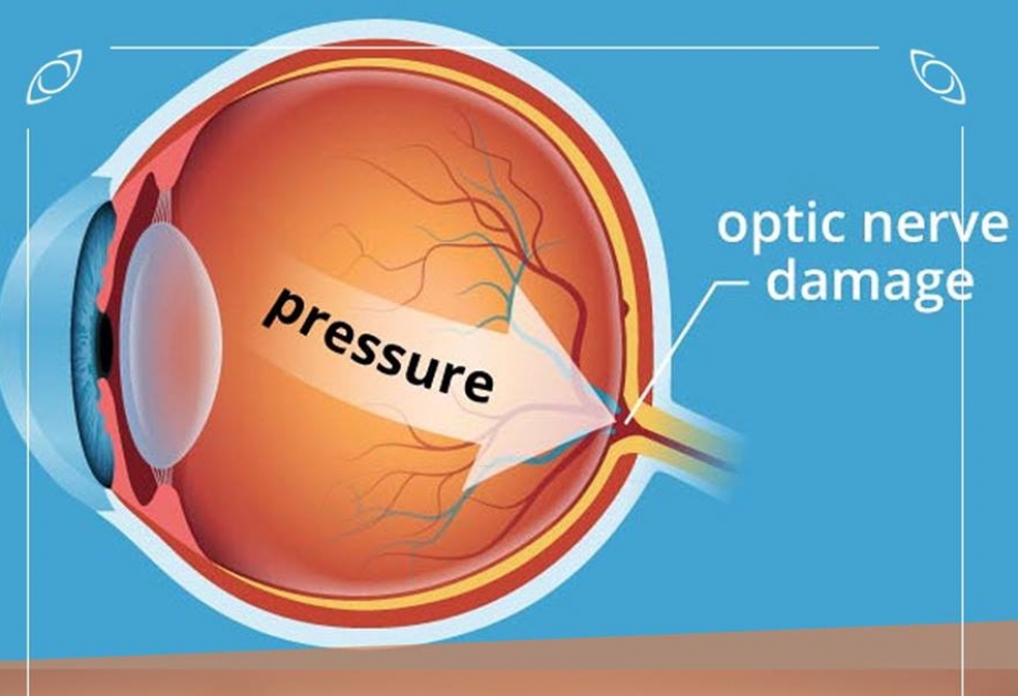 Офтальмолог Айтен Султанова: Внутриглазное давление в здоровых глазах – не патологическое, а физиологическое явление
