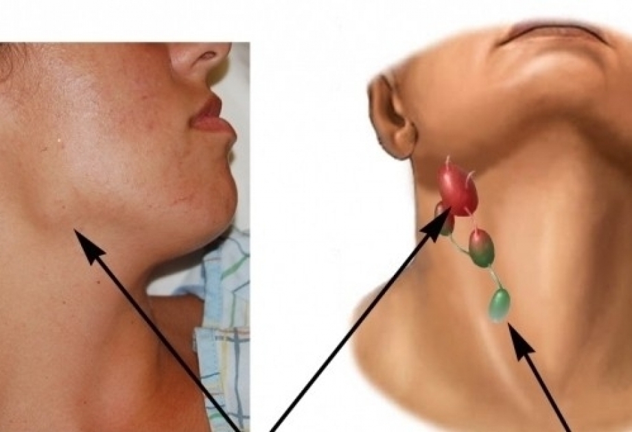 Сегодня Всемирный день борьбы с лимфомами