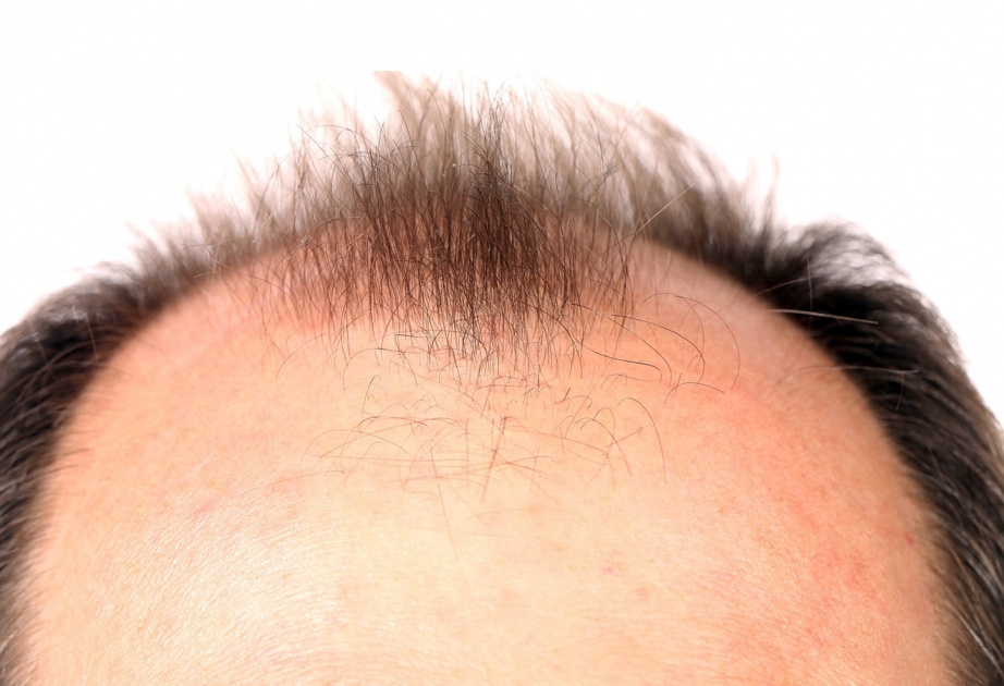Biochemikalie bewirkt normalen Haarwuchs