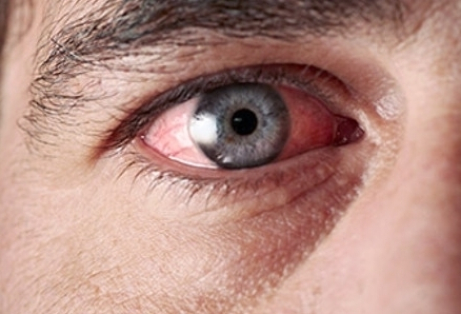 Study links 3 eye diseases with Alzheimer`s