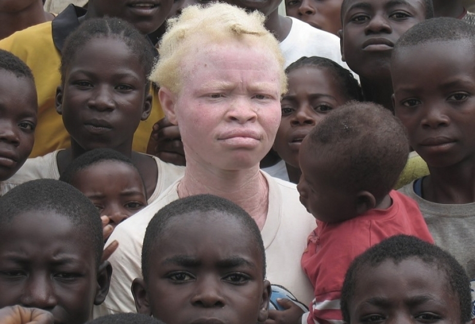 ООН: Кения серьезно продвинулась в деле защиты людей с альбинизмом