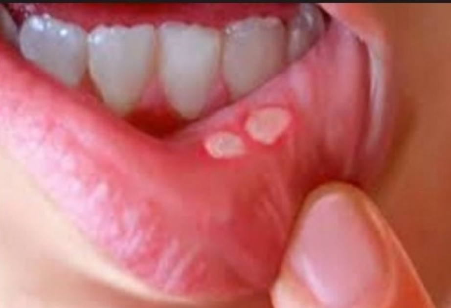 Aftoz stomatit ağız boşluğunda əmələ gələn iltihabi prosesdir