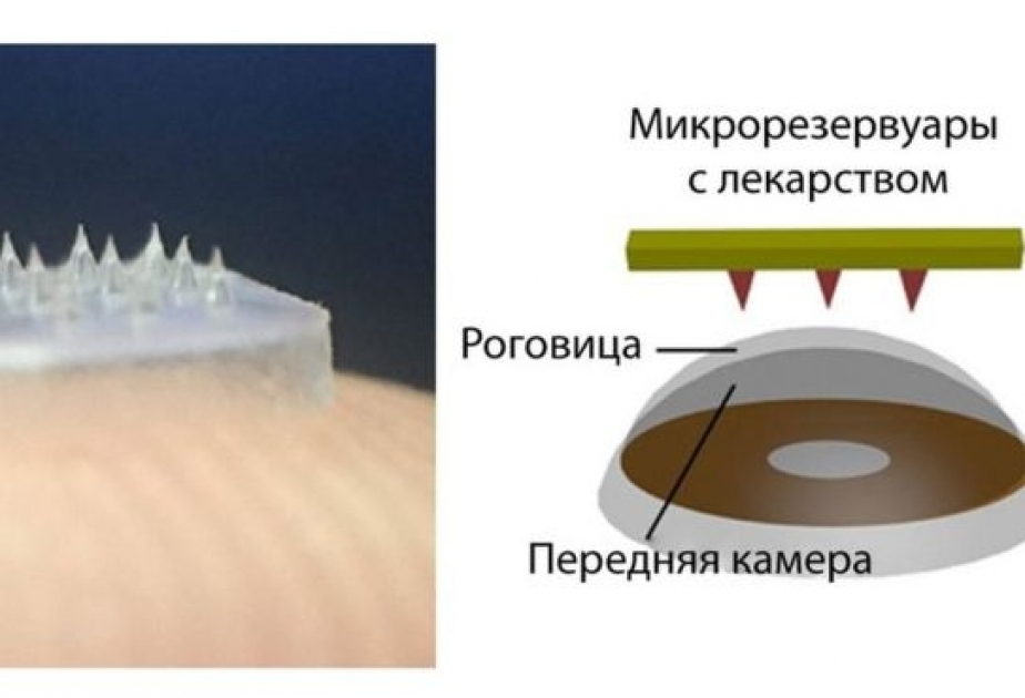 Китайские ученые изобрели контактные линзы с шипами