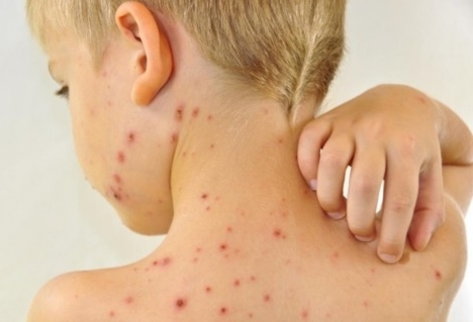 Praqanı qızılca epidemiyası cənginə alıb