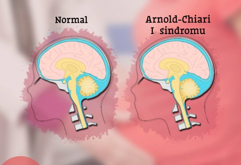 Arnold-Çiari I sindromuna görə əməliyyat olunmuş qadın yenidən analıq sevincini yaşayıb