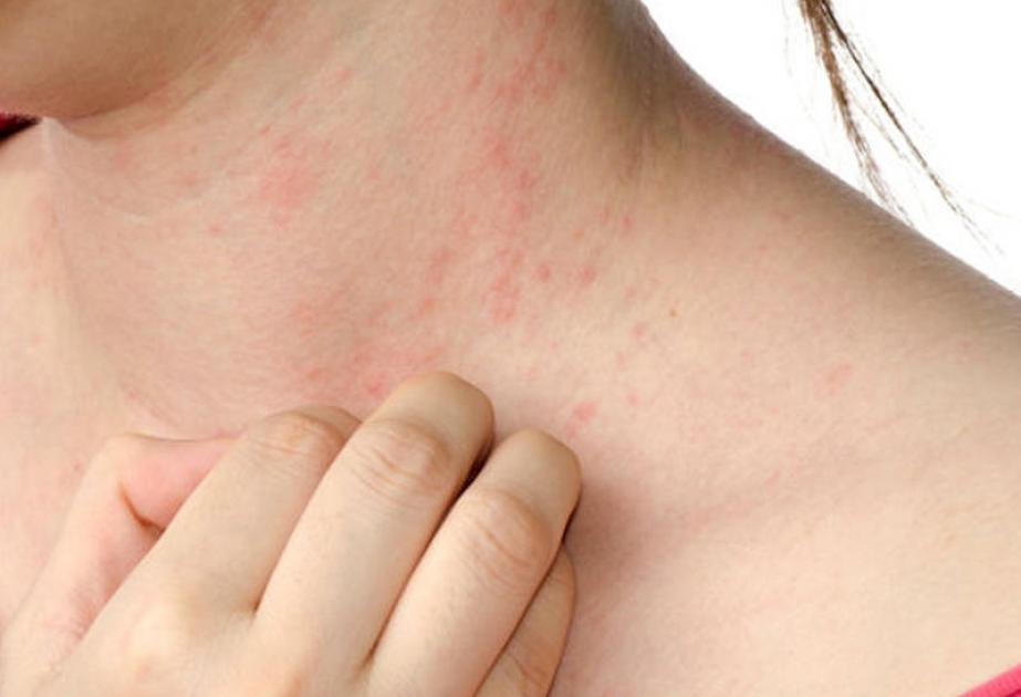 Allergik təmas dermatiti və onunla mübarizə