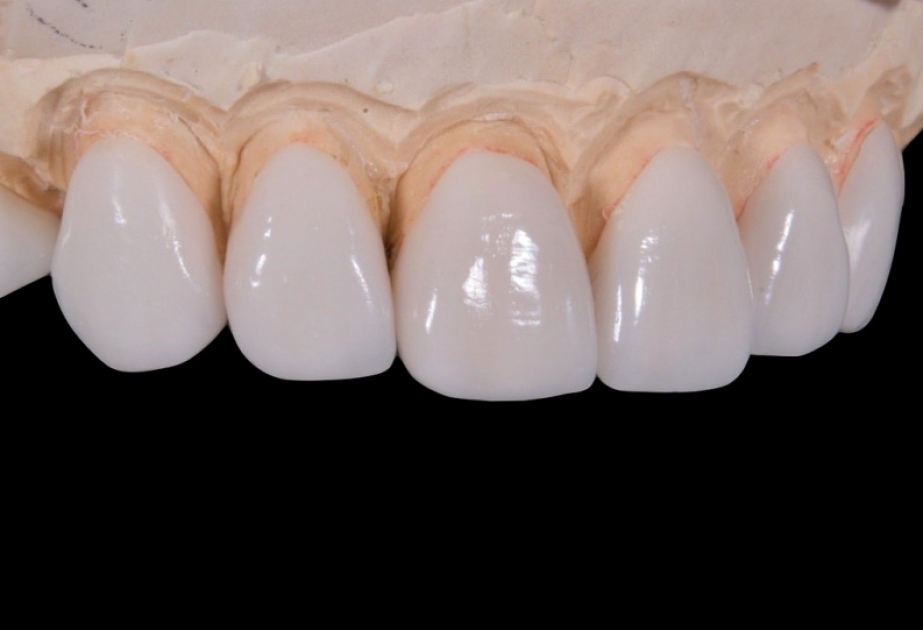 Médicos chinos logran hacer crecer el esmalte dental