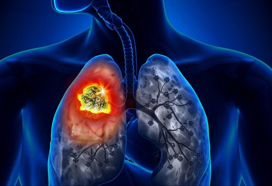 Три распространенных лекарства предотвращают рак легких