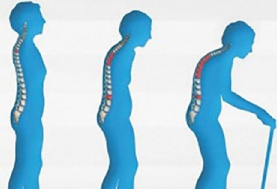 Oktyabrın 20-si Ümumdünya Osteoporozla Mübarizə Günüdür