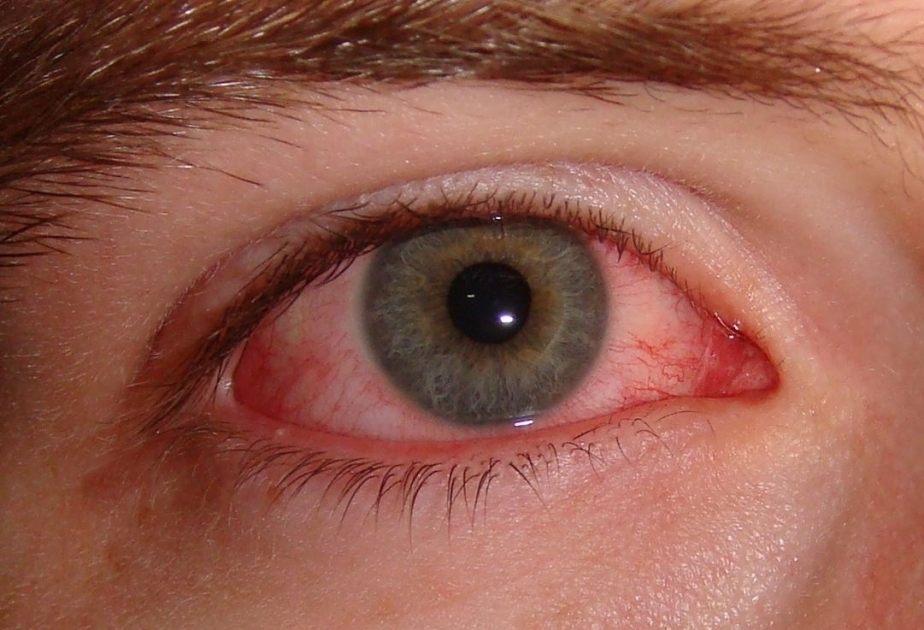 Varias enfermedades de los ojos pueden ser causadas como resultado de la infección