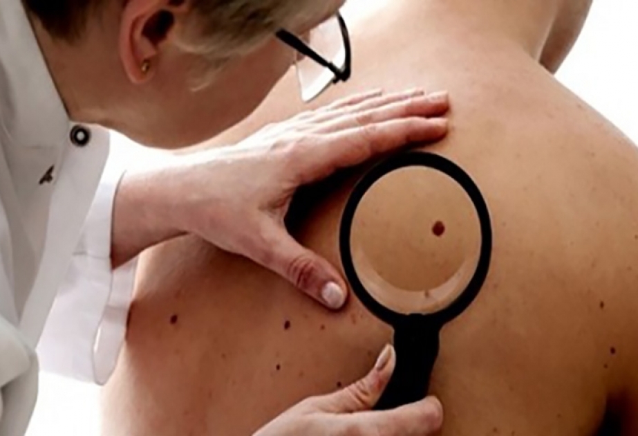Həkim-dermatoloq: Xallara ehtiyatla yanaşmaq lazımdır