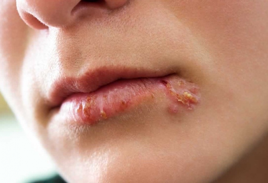 Herpes virusu və onunla mübarizə yolları