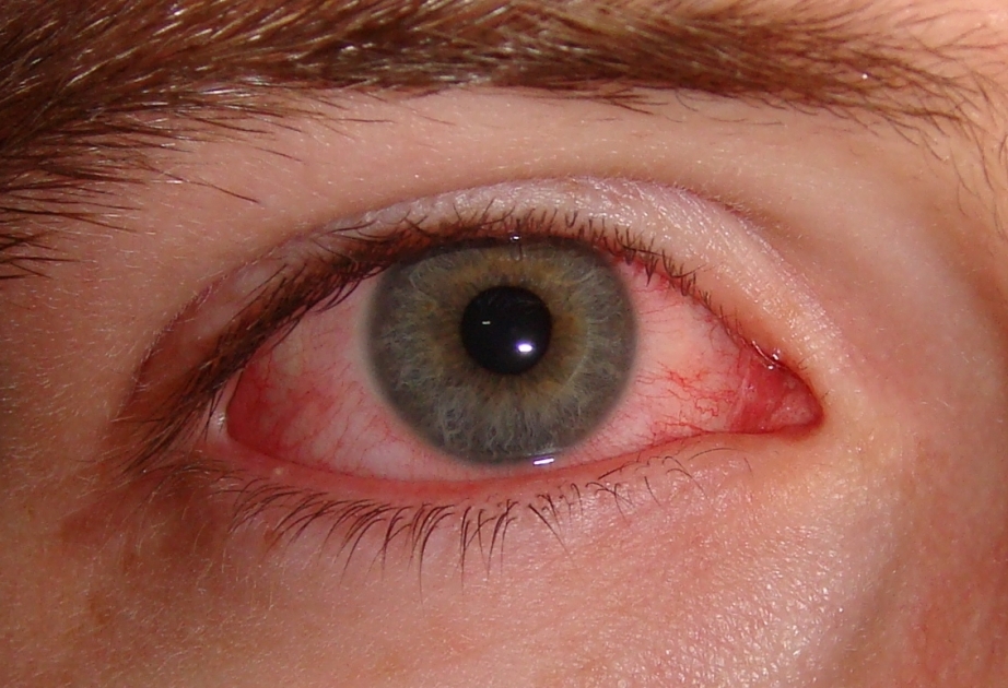 Allergik konyunktivit daha çox oğlanlarda rast gəlinir və onlar həmin patologiyanı ağır keçirirlər