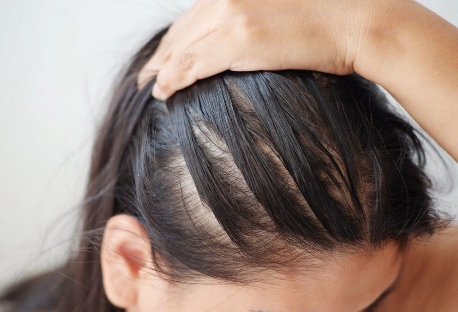 Mütəxəssislər saçların tökülməsini şərtləndirən altı səbəbi müəyyənləşdiriblər