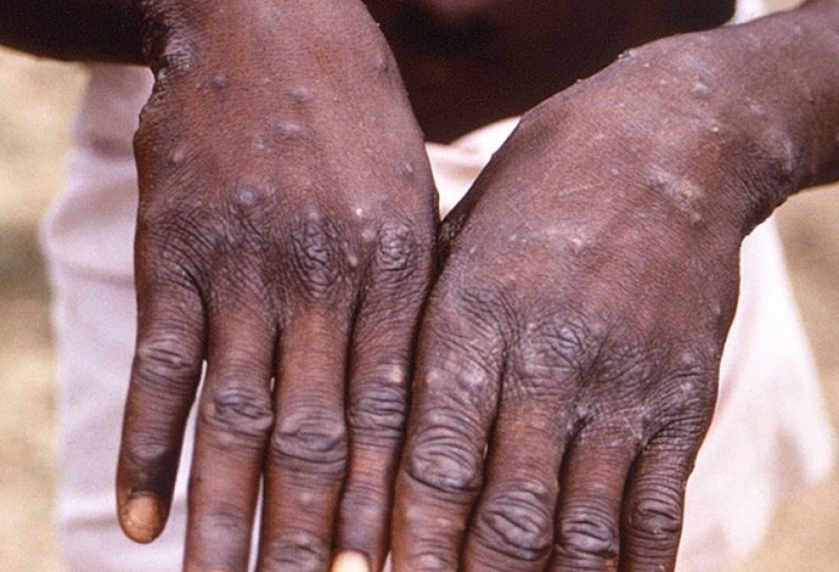 Minimal risk of monkeypox transmission in UK following confirmed case