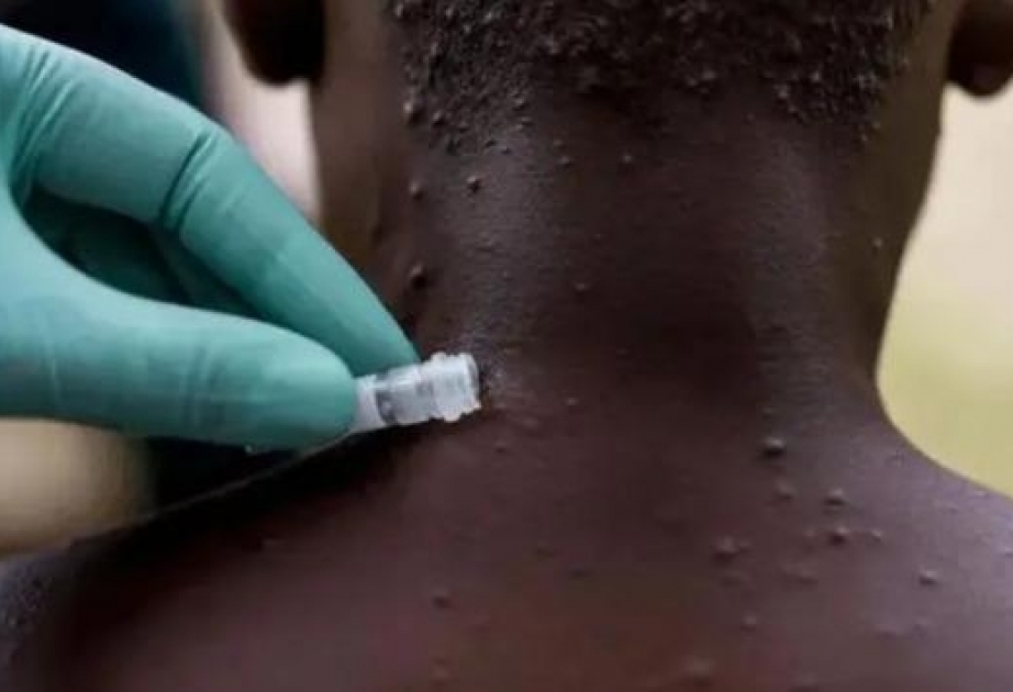 世卫组织：全球已发现约80例猴痘病例