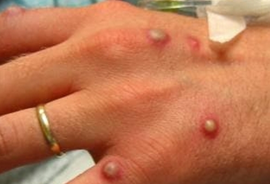 Europe: WHO supporting countries affected by rare monkeypox outbreak