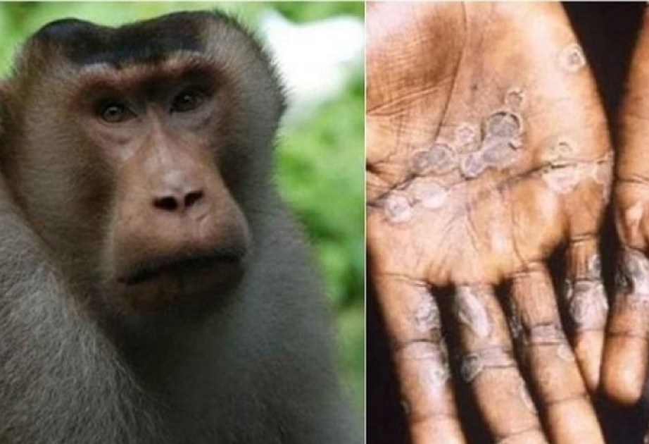 Оспа обезьян в Африке: старый вирус с тысячами случаев в год и десятками смертельных исходов