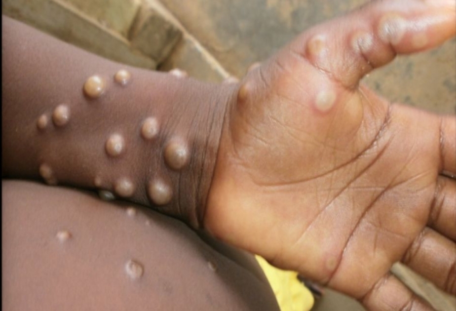 131 monkeypox cases confirmed outside Africa, WHO says 'containable'