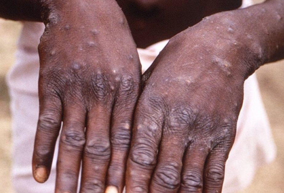 L’OMS : La flambée de variole du singe reste maîtrisable