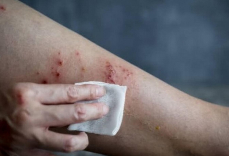 La OMS no recomienda la vacunación masiva contra la viruela del mono