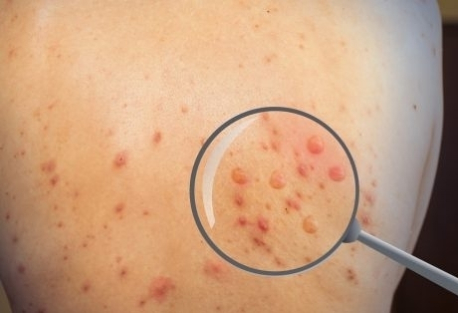 WHO working on changing name of monkeypox virus