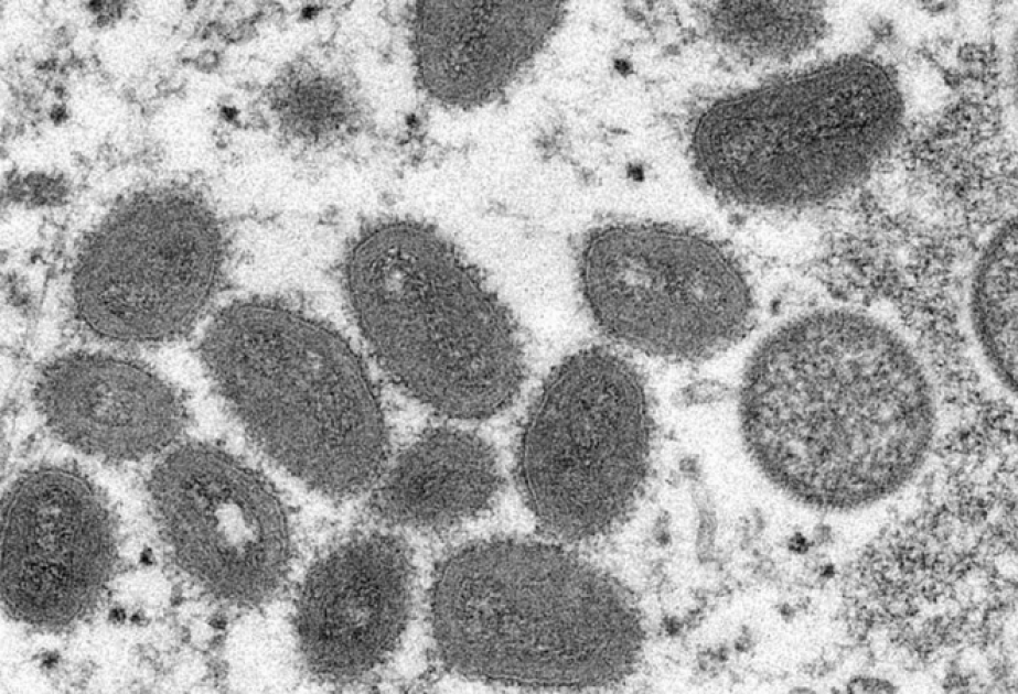 Plus de 5 300 cas de variole du singe confirmés dans le monde dont 85% en Europe