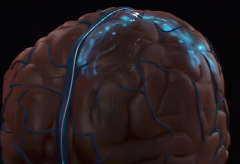 В США впервые в мозг человека внедрили постоянный имплант