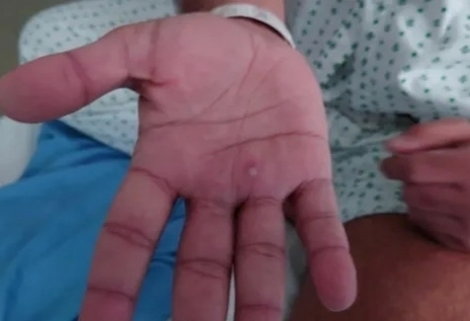 Spain, Brazil announce first monkeypox-related deaths outside Africa