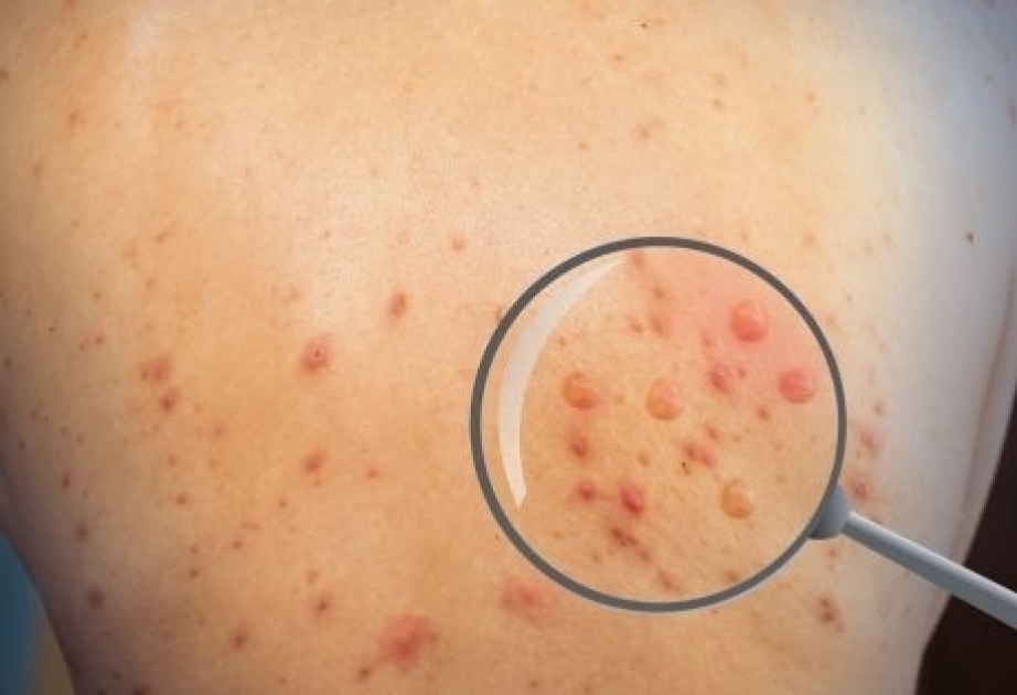 OMS: “Se detectan 35 mil casos de viruela del mono en 92 países del mundo; 12 de los infectados murieron”