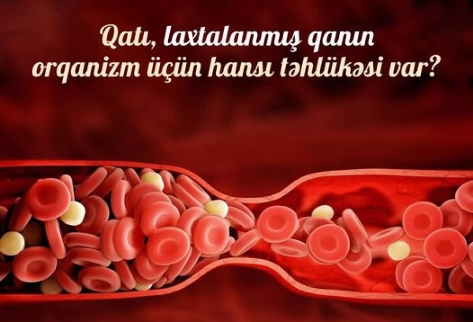 Koronavirusa yoluxan insanlarda qan laxtalanması problemi müşahidə edilir