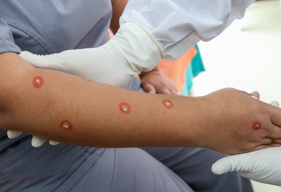 Russia detects second case of monkeypox