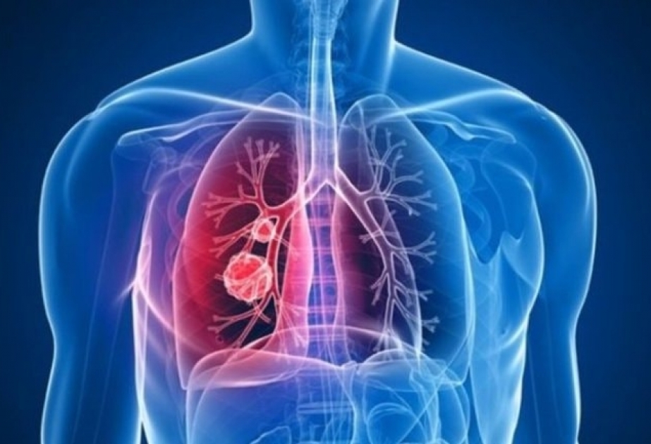 Həkim-ftiziatr: Vərəmin dərmana davamlı forması daha ağır gedişata malik olur