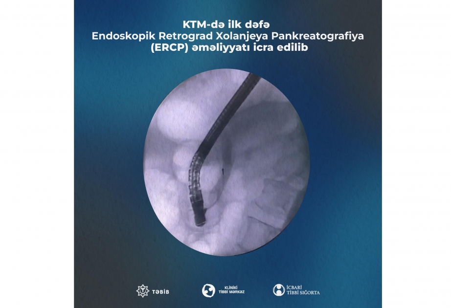 Dövlət xəstəxanaları arasında ilk dəfə Klinik Tibbi Mərkəzdə ERCP əməliyyatı icra edilib