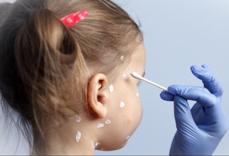 Quels sont les symptômes de la varicelle ?