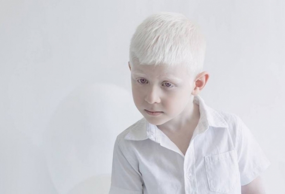 İyunun 13-ü Beynəlxalq Albinizm haqqında Maarifləndirmə Günüdür
