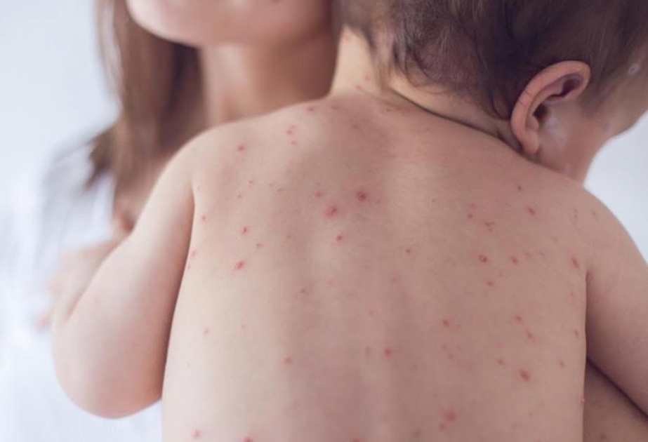 В Кыргызстане вспышка кори: 2 тысячи заболевших