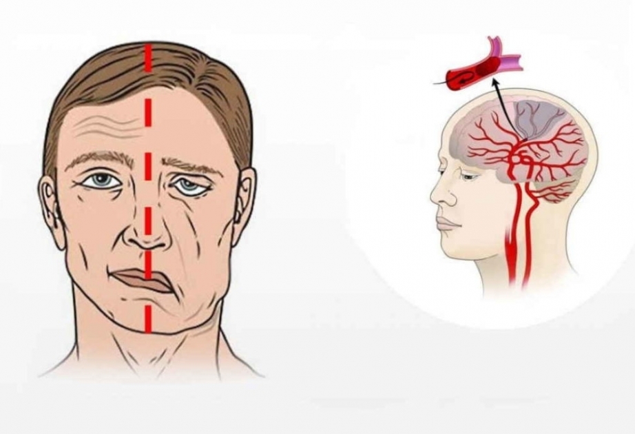 El ictus causará 10 millones de muertes anuales hasta 2050